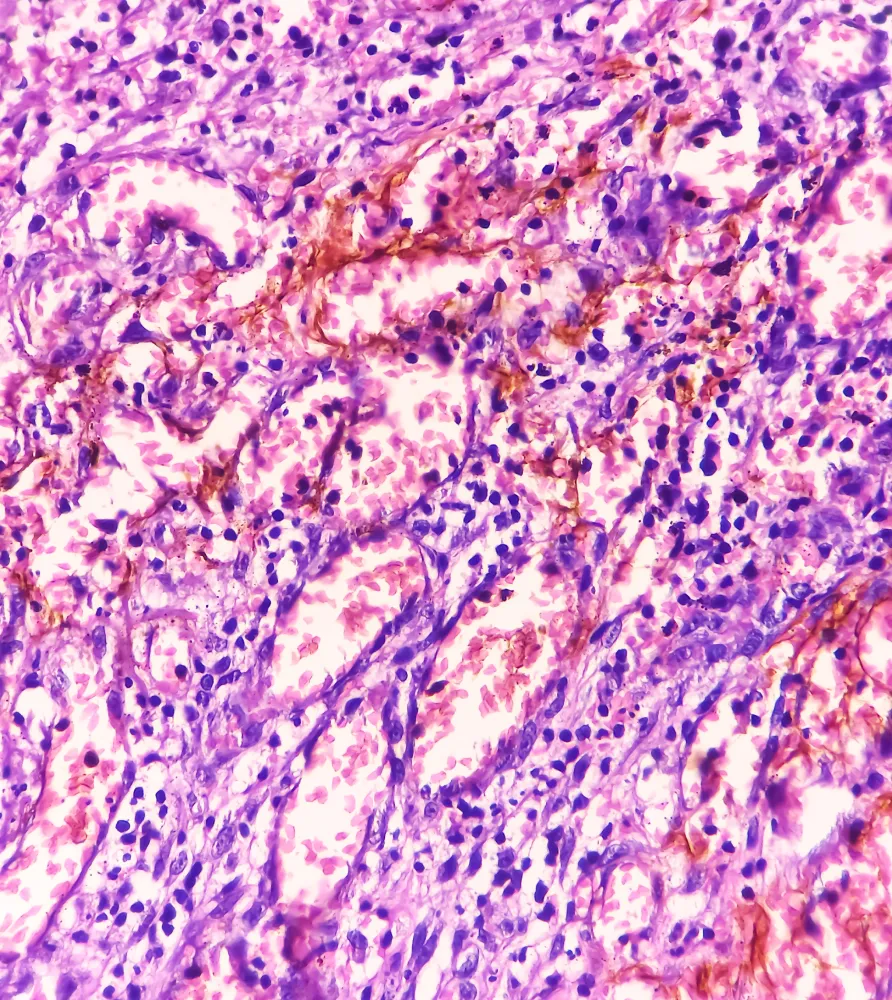 img what causes an epididymal blockage 2x